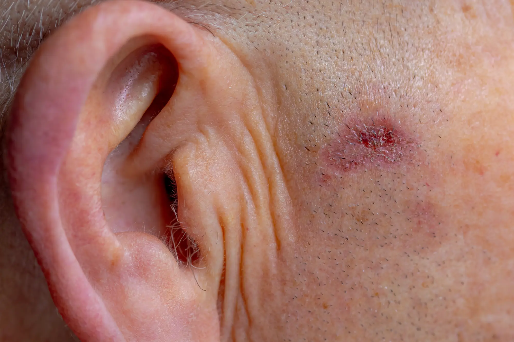 an example of skin cancer